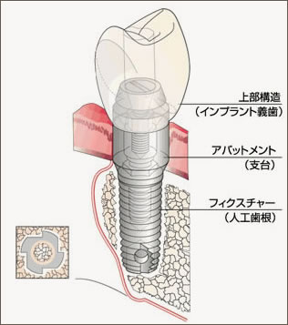 インプラントの構造